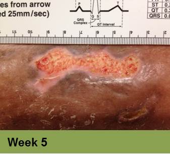 WinVivo - Clinical Case Report Venous Leg Ulcers