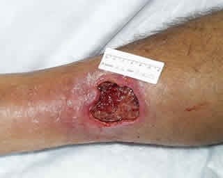 WinVivo - Venous Leg Ulcers
